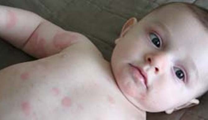 Профилактика аллергии в раннем возрасте